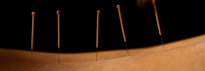 Chiropractic Rockville MD Dry Needling On Back